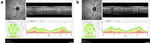 Optical coherence tomography (OCT) in patients with Parkinson’s Disease (PD)